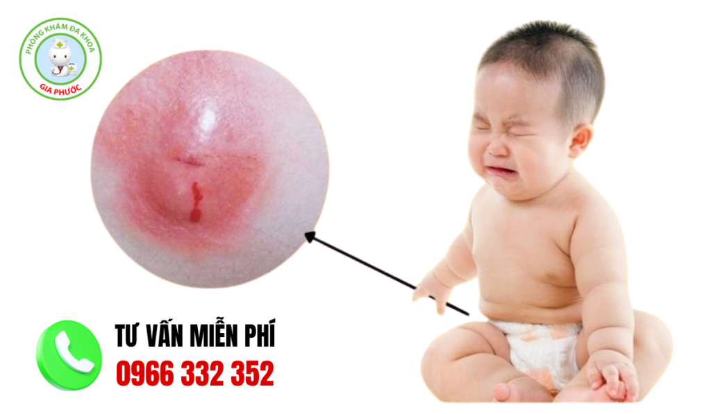 Hình Ảnh Áp Xe Hậu Môn Người Lớn, Trẻ Nhỏ Và Cách Điều Trị 4 hình ảnh áp xe hậu môn