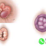 15+ Hình Ảnh Bệnh Trĩ Ngoại Qua Các Giai Đoạn Phát Triển 8 hình ảnh bệnh trĩ ngoại