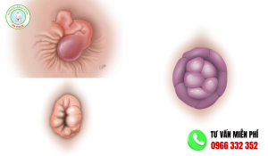 hình ảnh bệnh trĩ ngoại