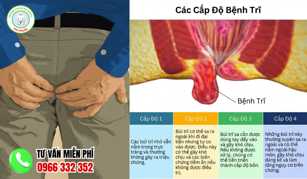 hình ảnh bệnh trĩ ngoại
