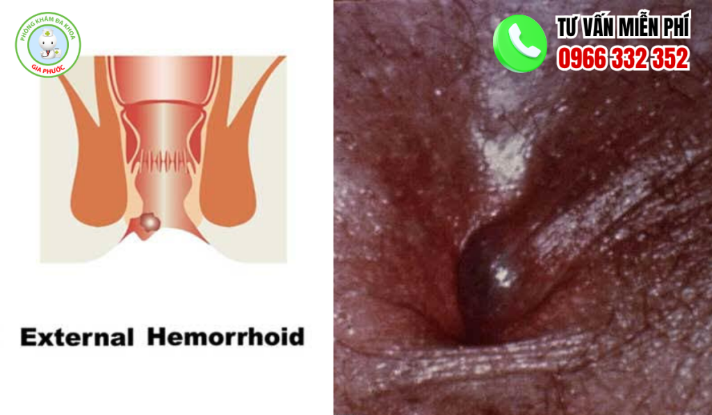 hình ảnh bệnh trĩ ngoại