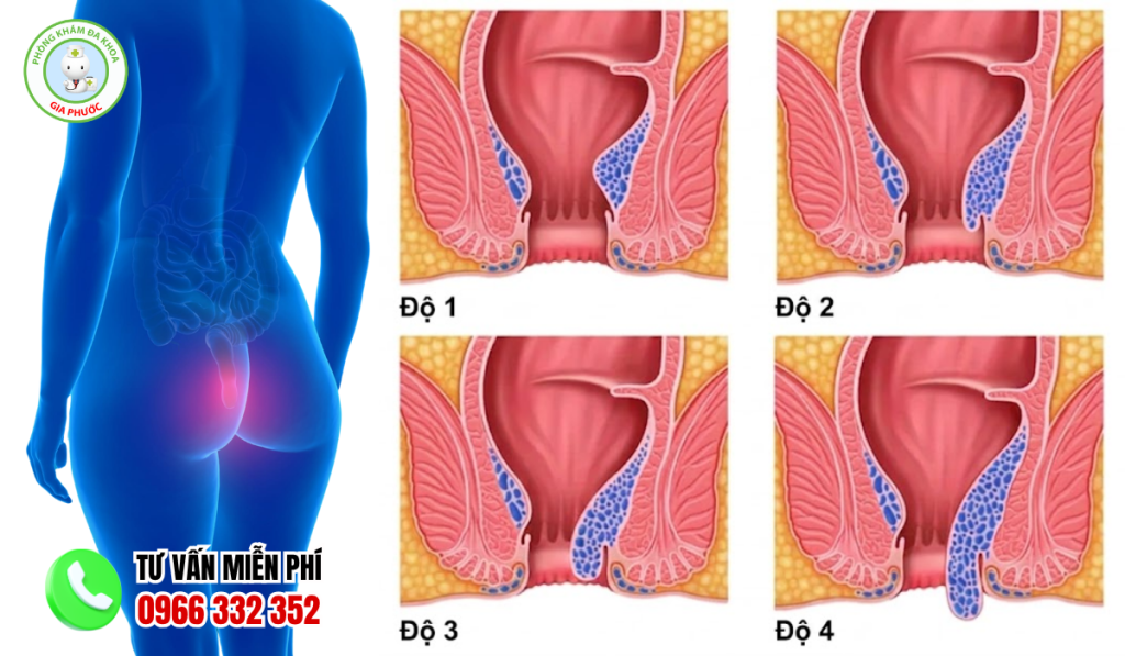 15+ Hình Ảnh Bệnh Trĩ Nội Theo Từng Cấp Độ Chi Tiết Nhất 2 Hình ảnh bệnh trĩ nội