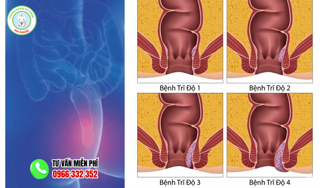 15+ Hình Ảnh Bệnh Trĩ Nội Theo Từng Cấp Độ Chi Tiết Nhất 4 hình ảnh bệnh trĩ nội