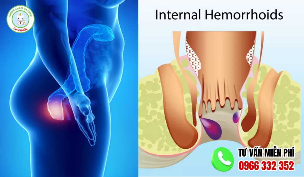 15+ Hình Ảnh Bệnh Trĩ Nội Theo Từng Cấp Độ Chi Tiết Nhất 3 hình ảnh bệnh trĩ nội