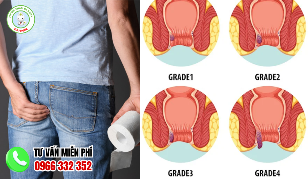 15+ Hình Ảnh Bệnh Trĩ Nội Theo Từng Cấp Độ Chi Tiết Nhất 1 hình ảnh bệnh trĩ nội