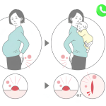 hình ảnh bệnh trĩ sau sinh