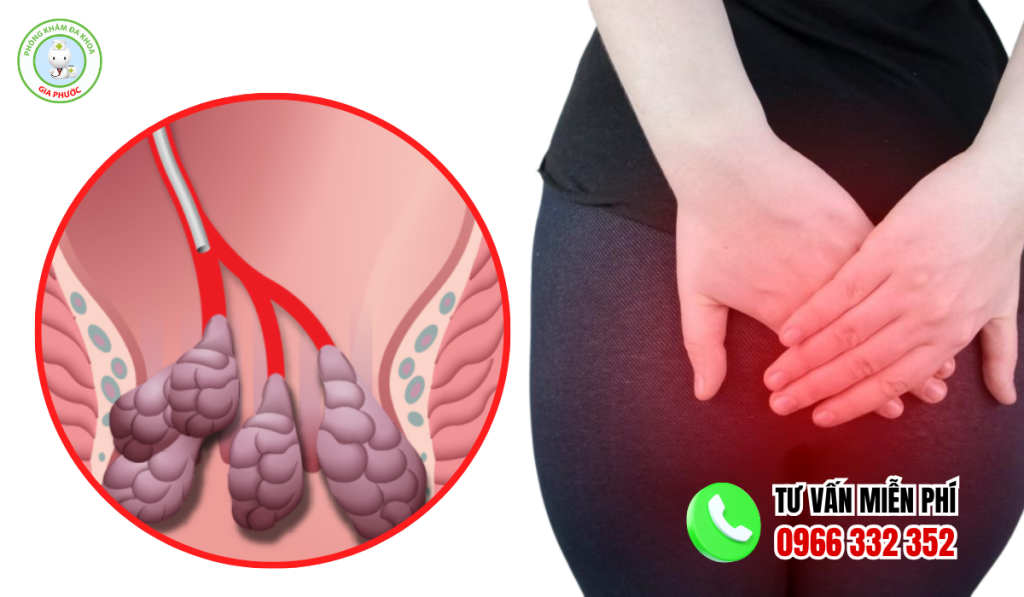 hình ảnh bệnh trĩ sau sinh