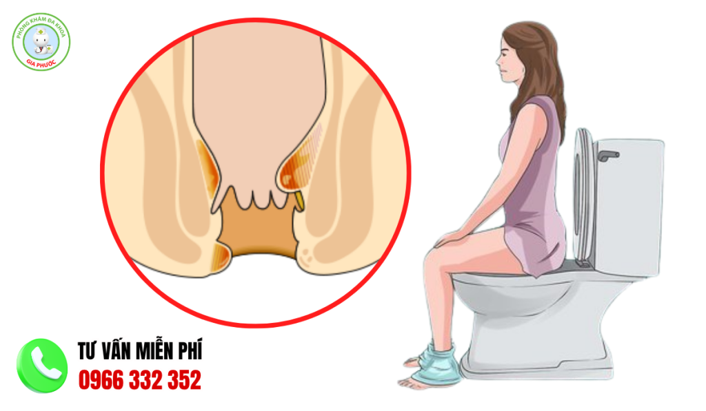 hình ảnh bệnh trĩ sau sinh