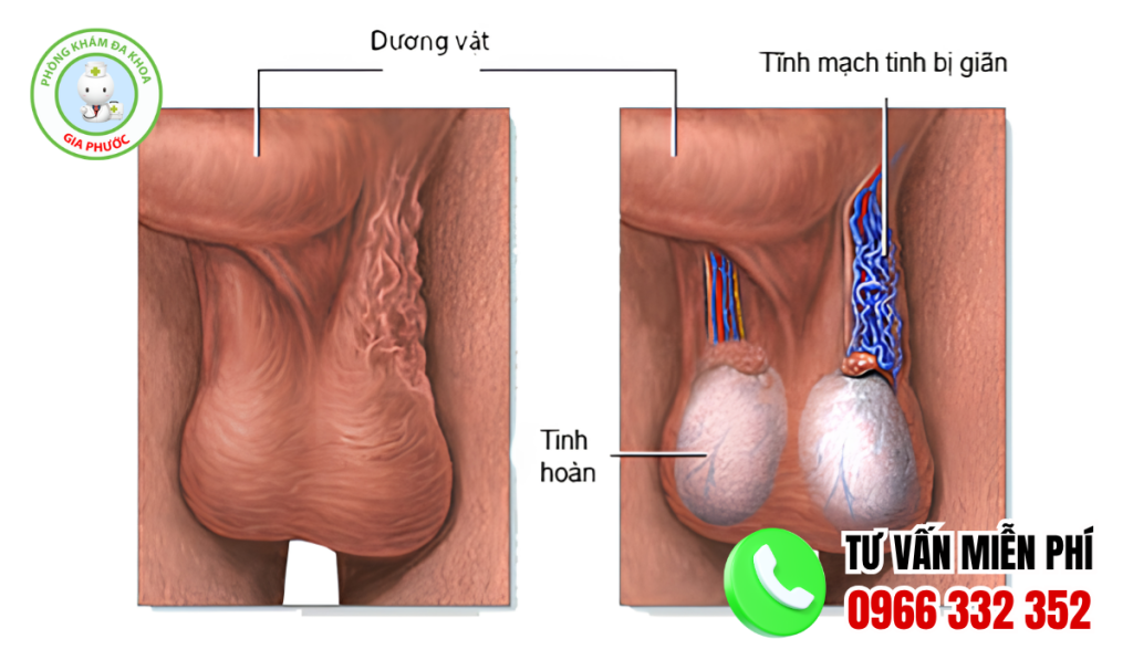 30 Hình Ảnh Bìu Bình Thường Và Bất Thường Ở Nam Giới 2 Hình ảnh bìu bình thường ở nam giới