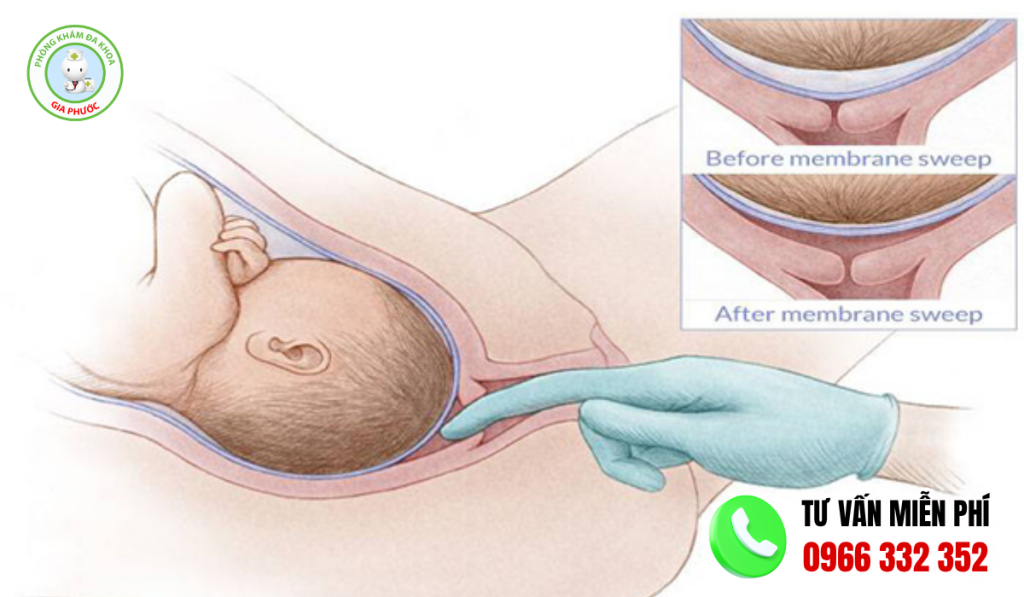 Hình ảnh cổ tử cung mở 1-3cm
