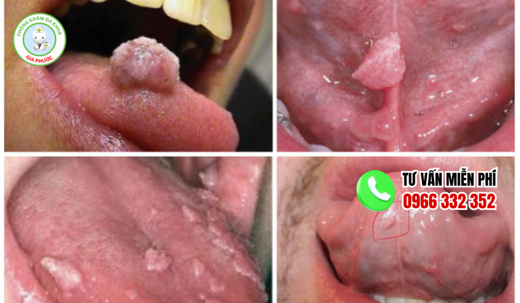 Hình ảnh gai lưỡi bất thường