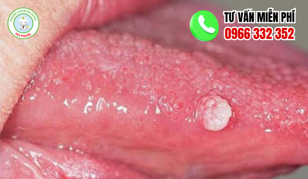 Hình ảnh gai lưỡi bất thường do sùi mào gà