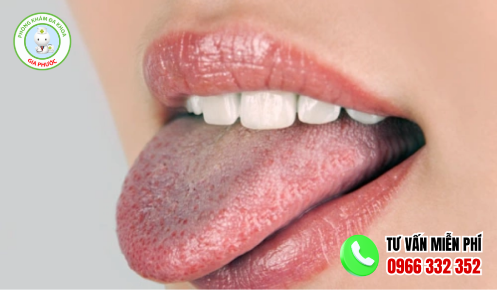 hình ảnh gai lưỡi bình thường