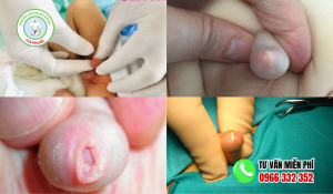 Hình ảnh hẹp bao quy đầu ở trẻ em