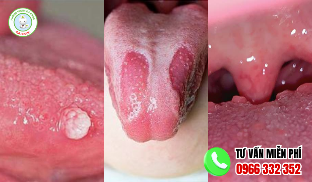 Hình ảnh lưỡi bị bệnh
