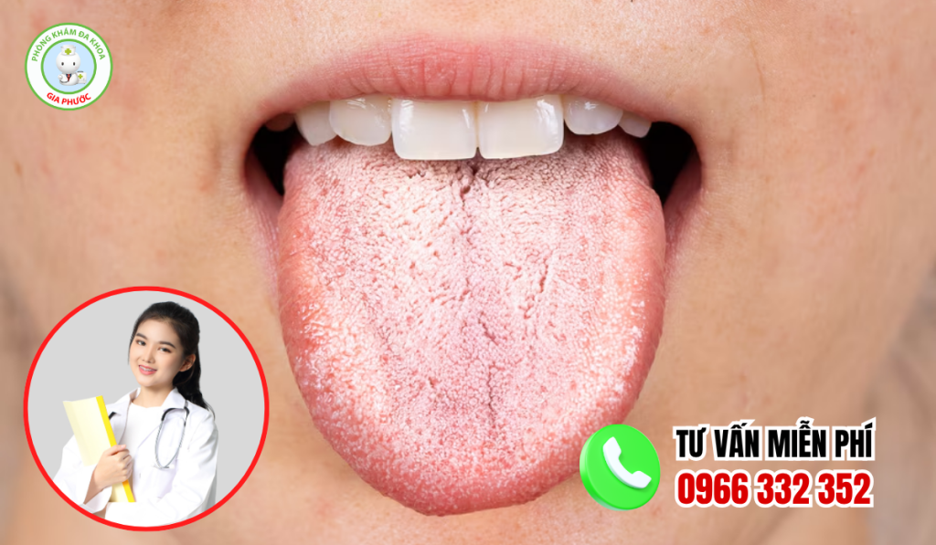 Hình ảnh lưỡi bị bệnh bọc lớp trắng đục