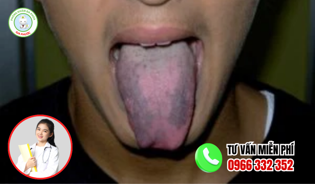 Hình ảnh lưỡi bị bệnh lông đen