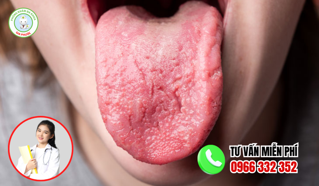 Hình ảnh lưỡi bị bệnh loang lỗ