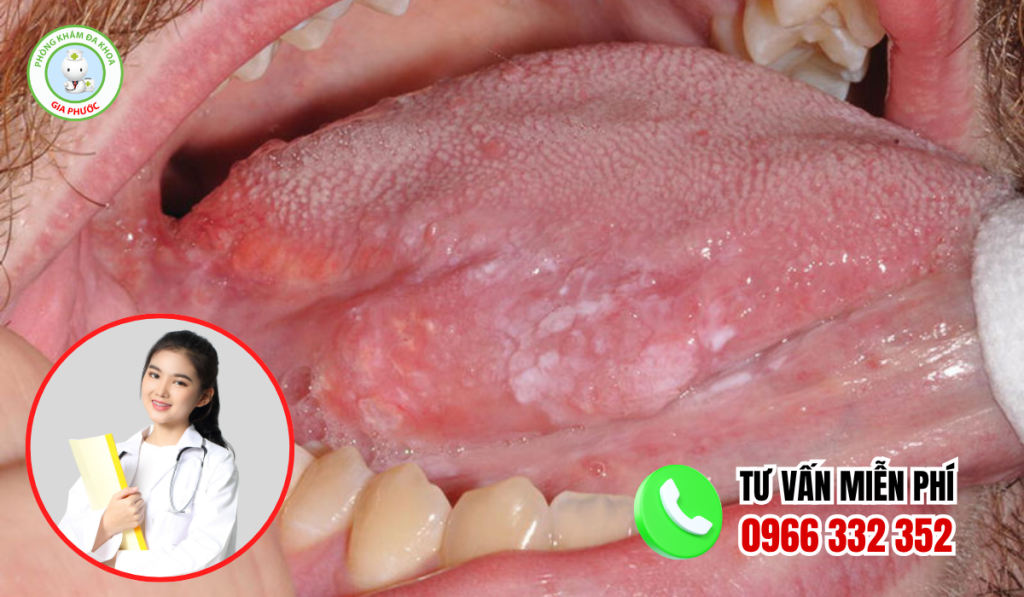 Hình ảnh lười bị bệnh sùi mào gà