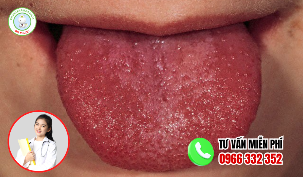 Hình ảnh lưỡi bị bệnh sưng đỏ