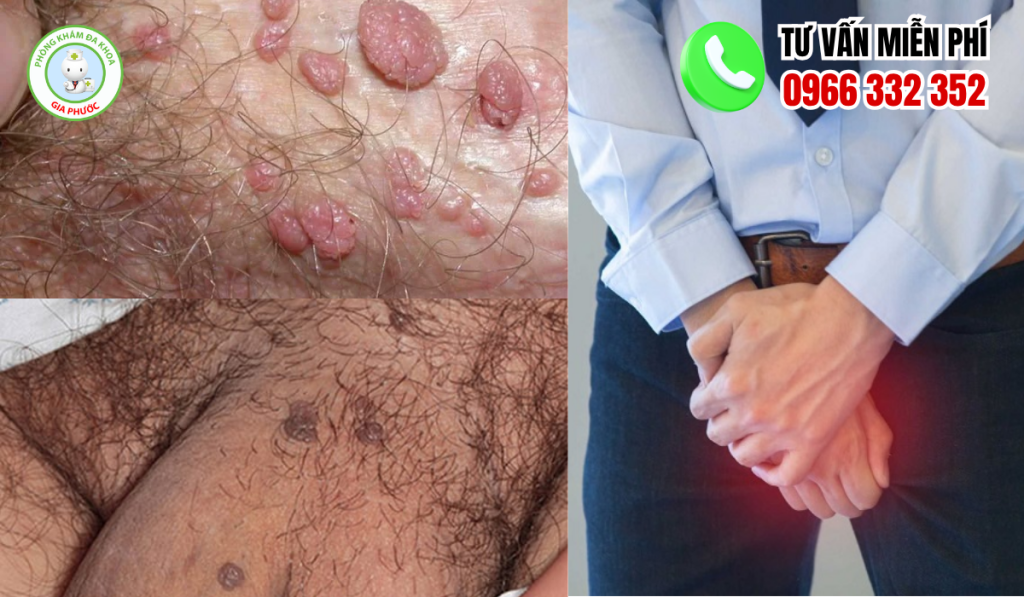 Hình ảnh nổi mụn vùng kín nam