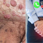 Hình ảnh nổi mụn vùng kín nam