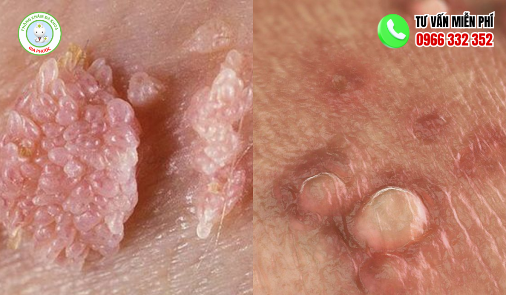 Hình Ảnh Nổi Mụn Ở Vùng Kín Nam Và Cách Điều Trị An Toàn 3 hình ảnh nổi mụn ở vùng kín nam