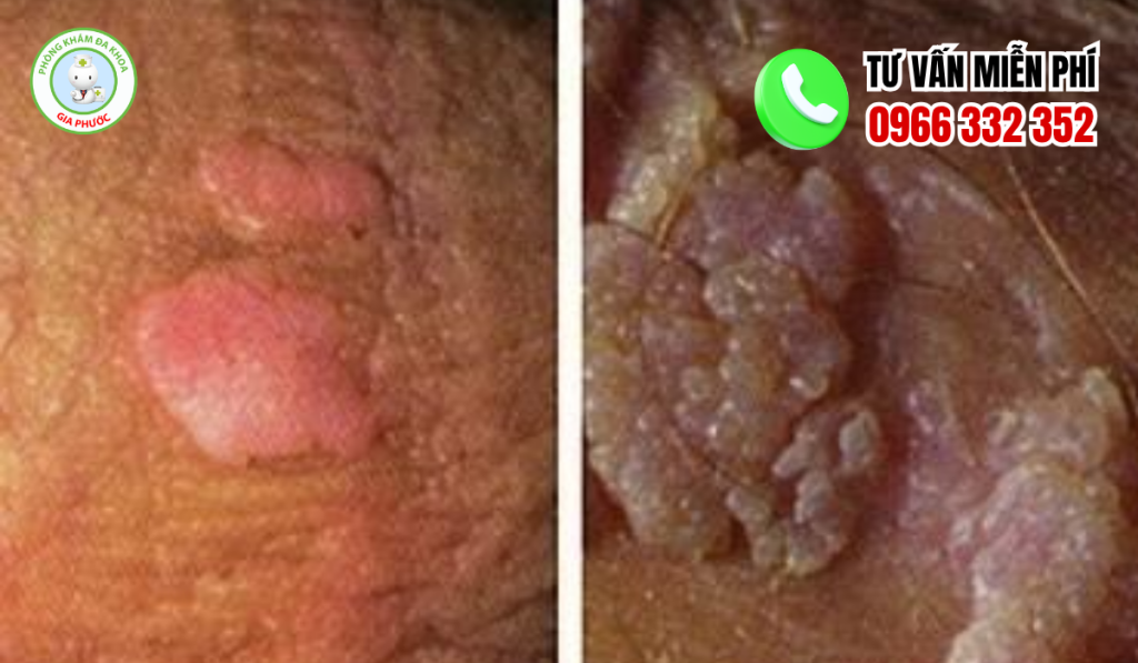 Hình ảnh nổi mụn vùng kín nam