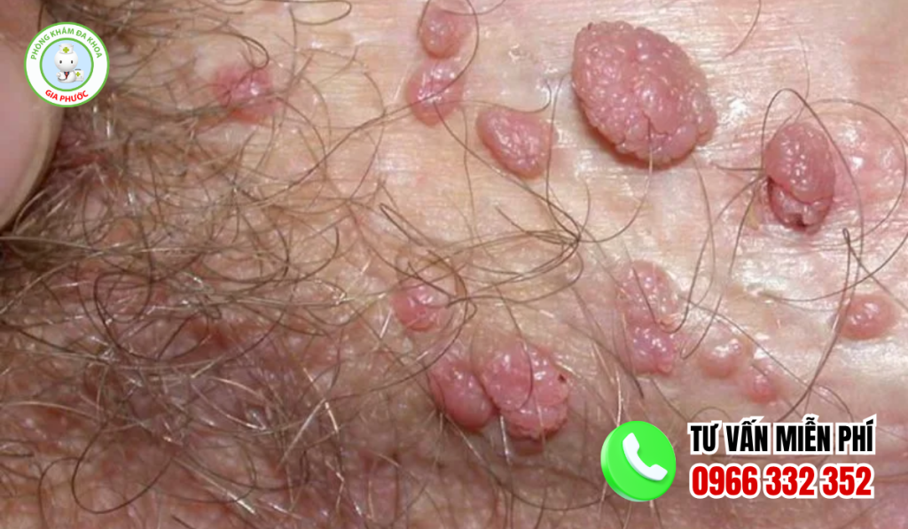 Hình ảnh nổi mụn vùng kín nam