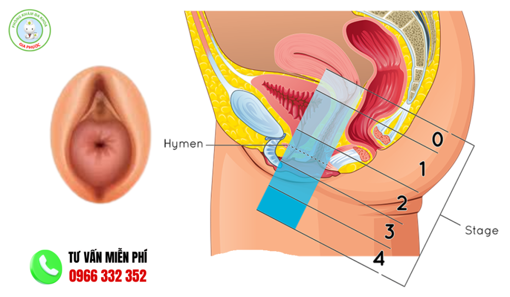 Hình ảnh sa tử cung độ 1