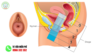 Hình ảnh sa tử cung độ 1