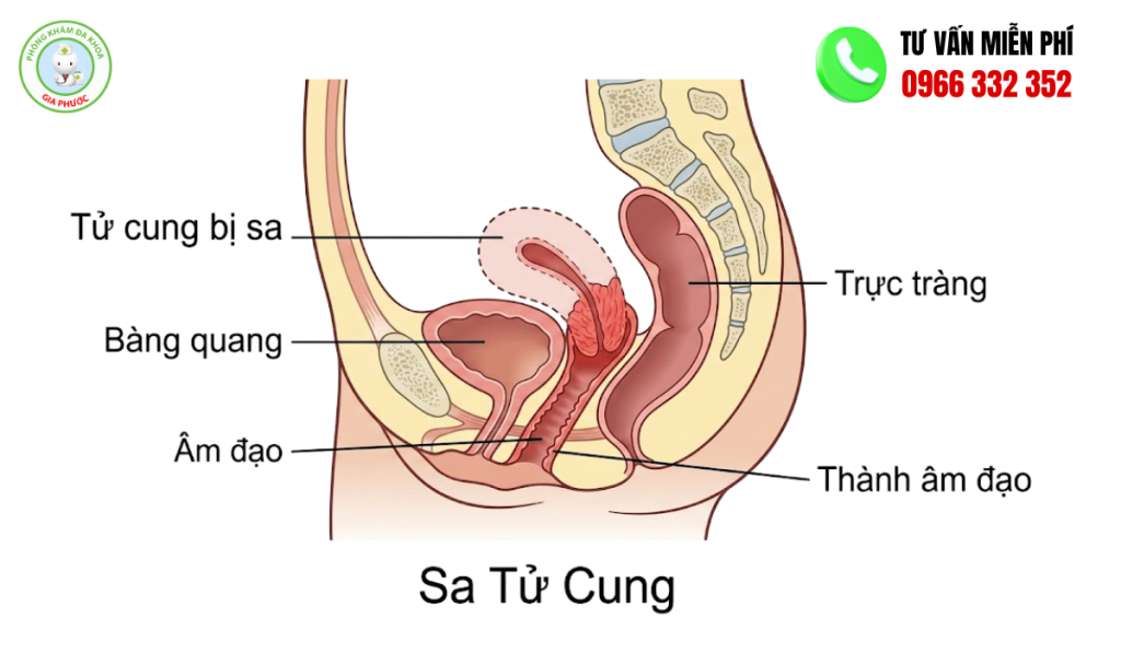 Hình ảnh sa tử cung độ 1 3D