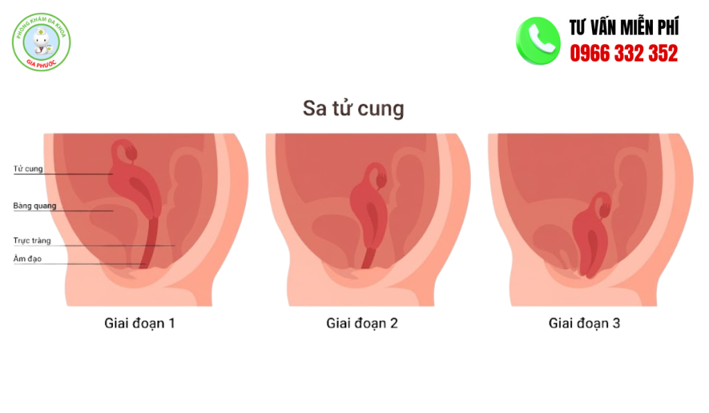 Hình ảnh sa tử cung độ 1