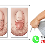 Hình ảnh sau khi nong bao quy đầu