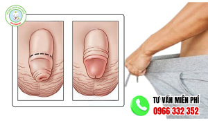 Hình ảnh sau khi nong bao quy đầu