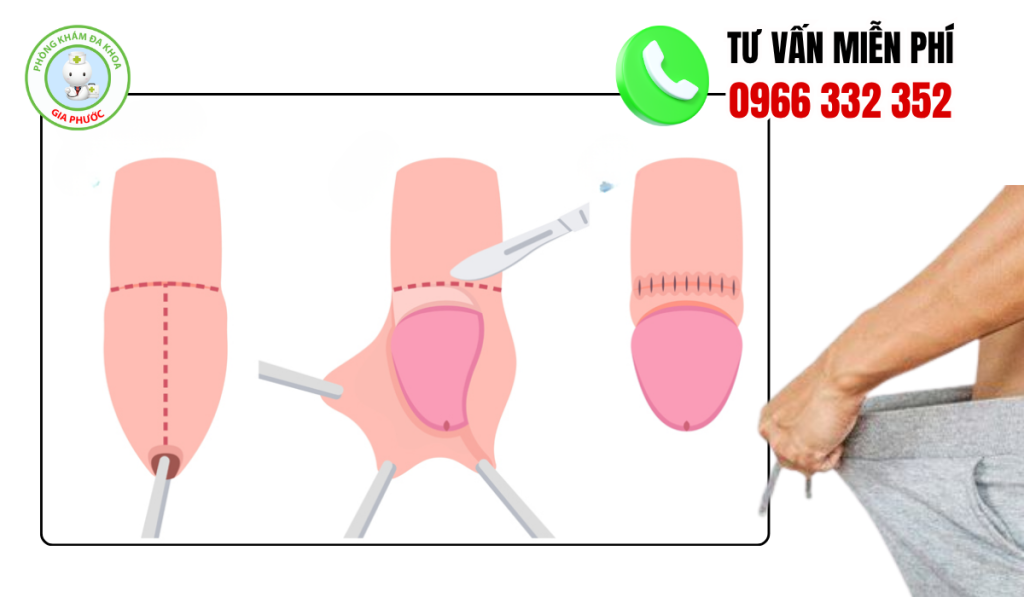 50 Hình Ảnh Sau Khi Nong Bao Quy Đầu Và Cách Chăm Sóc 5 Hình ảnh sau khi nong bao quy đầu dương vật