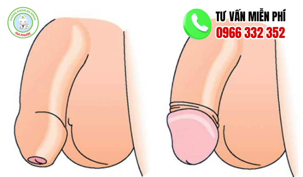 50 Hình Ảnh Sau Khi Nong Bao Quy Đầu Và Cách Chăm Sóc 3 Hình Ảnh Sau Khi Nong Bao Quy Đầu