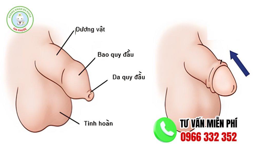 50 Hình Ảnh Sau Khi Nong Bao Quy Đầu Và Cách Chăm Sóc 4 Hình Ảnh Sau Khi Nong Bao Quy Đầu ở Nam
