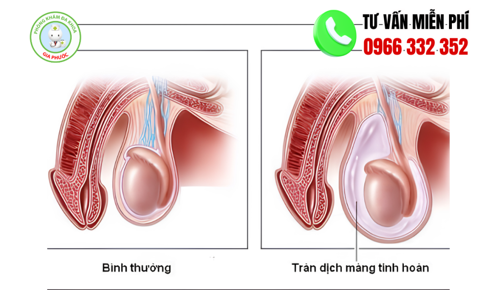 Hình ảnh tinh hoàn bất thường