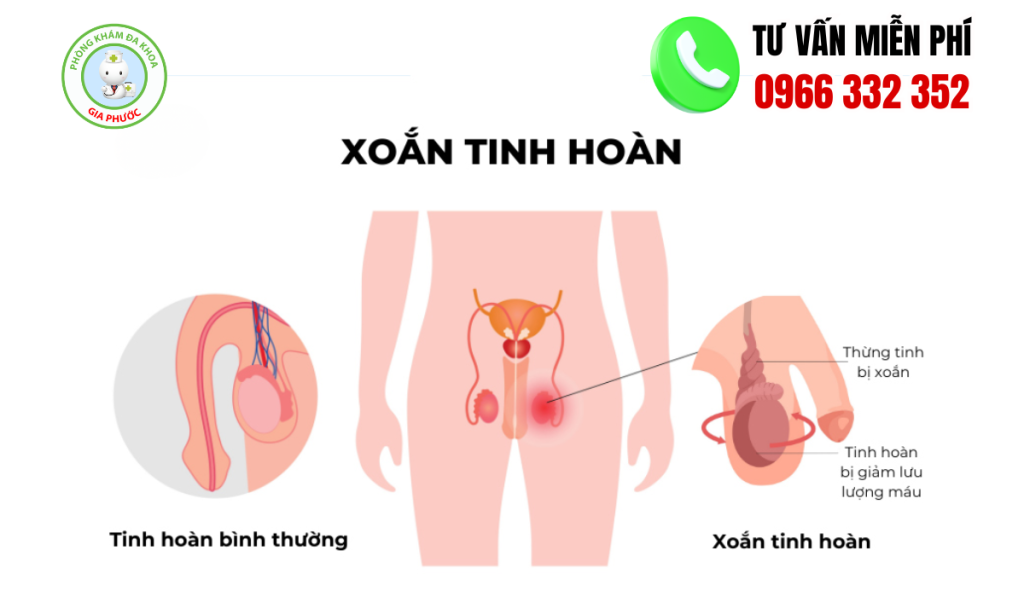 Hình ảnh tinh hoàn bất thường