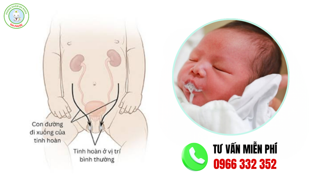 hình ảnh tinh hoàn bình thường ở trẻ sơ sinh