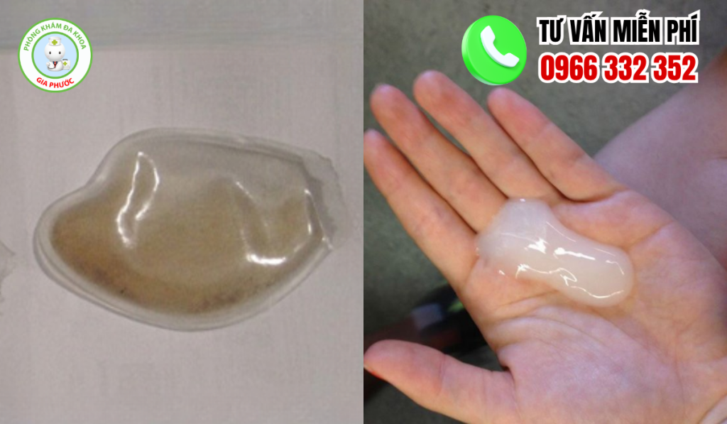 20 Hình Ảnh Tinh Trùng Vón Cục Như Thạch Ở Nam Giới Và Cách Chữa 2 Hình ảnh tinh trùng vón cục như thạch