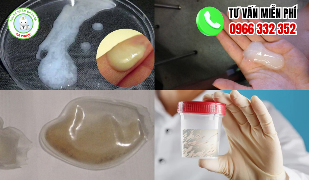 20 Hình Ảnh Tinh Trùng Vón Cục Như Thạch Ở Nam Giới Và Cách Chữa 1 Hình ảnh tinh trùng vón cục như thạch