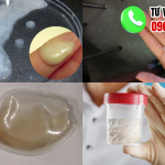 Hình ảnh tinh trùng vón cục như thạch