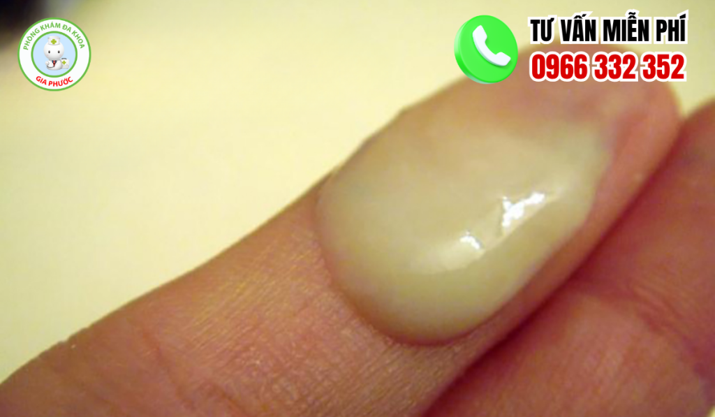 20 Hình Ảnh Tinh Trùng Vón Cục Như Thạch Ở Nam Giới Và Cách Chữa 4 Hình ảnh tinh trùng vón cục như thạch