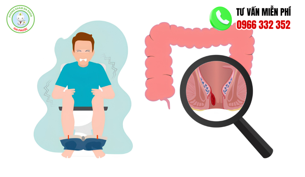 15+ Hình Ảnh Bệnh Trĩ Nội Theo Từng Cấp Độ Chi Tiết Nhất 5 Hình ảnh trĩ nội