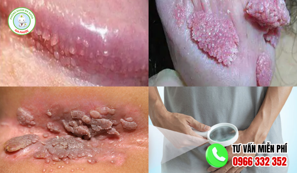 Hình Ảnh Trước Và Sau Khi Điều Trị Sùi Mào Gà Ở Nam Và Nữ 5 Hình ảnh trước và sau khi điều trị sùi mào gà