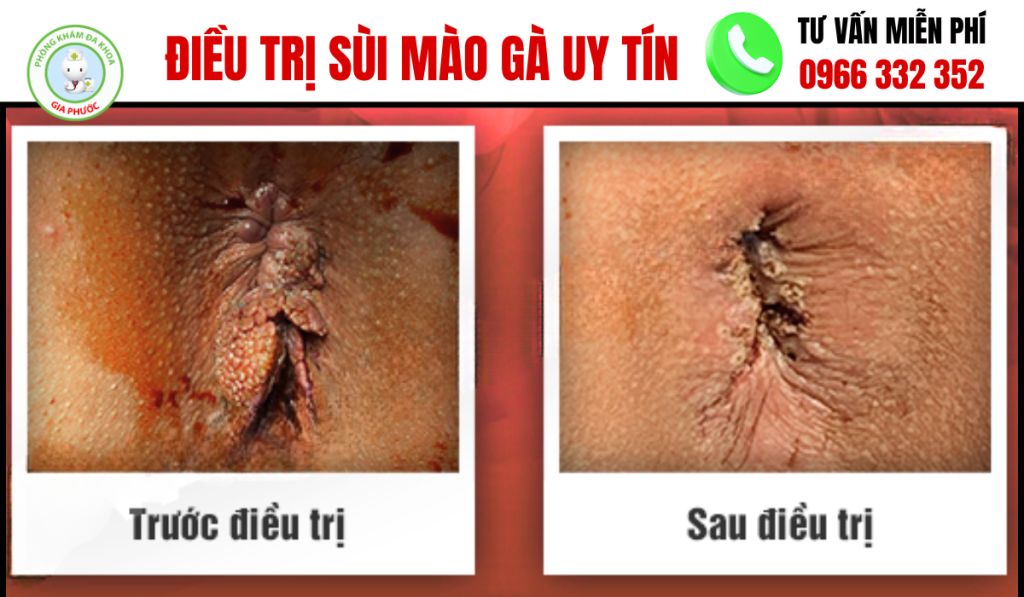 Hình Ảnh Trước Và Sau Khi Điều Trị Sùi Mào Gà Ở Nam Và Nữ 3 Hình Ảnh Trước Và Sau Khi Điều Trị Sùi Mào Gà