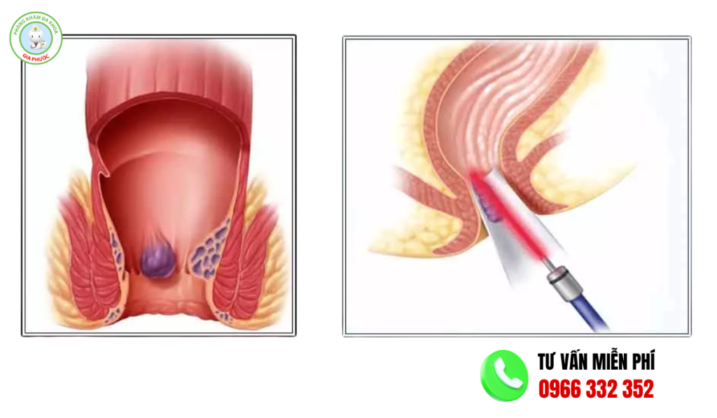 Hình ảnh trước và sau khi cắt trĩ