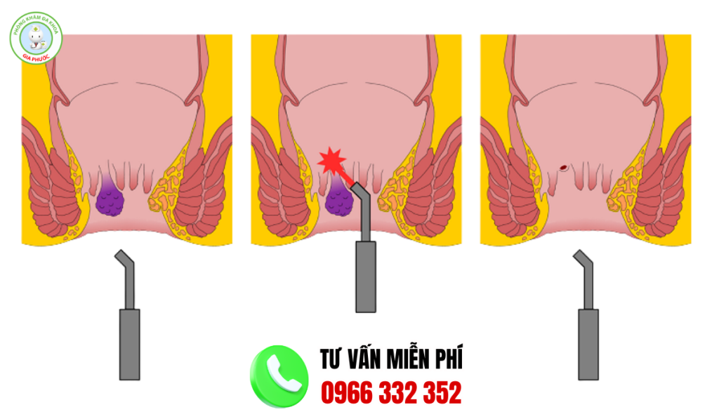 Hình ảnh trước và sau khi cắt trĩ
